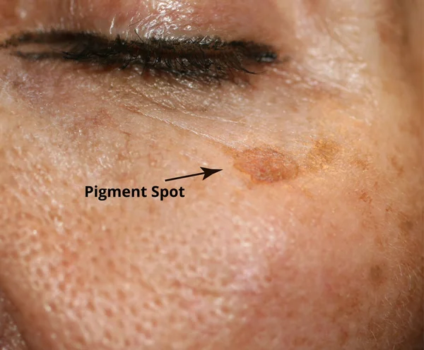 Brown spot on the skin of the face. Pigmentation on the skin