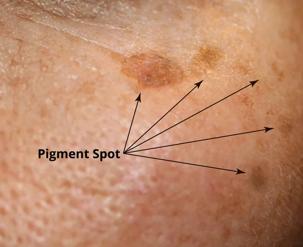 Brown spot on the skin of the face. Pigmentation on the skin — Stock Photo, Image