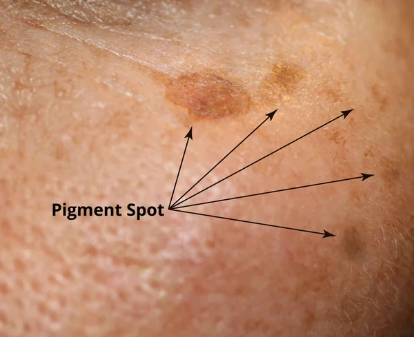 Brun fläck på huden i ansiktet. Pigmentering på huden — Stockfoto