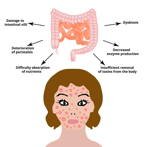 腸の解剖学的構造。腸疾患は皮膚に影響を与えます。皮膚の炎症やにきび。孤立した背景のベクトル図 — ストックベクタ
