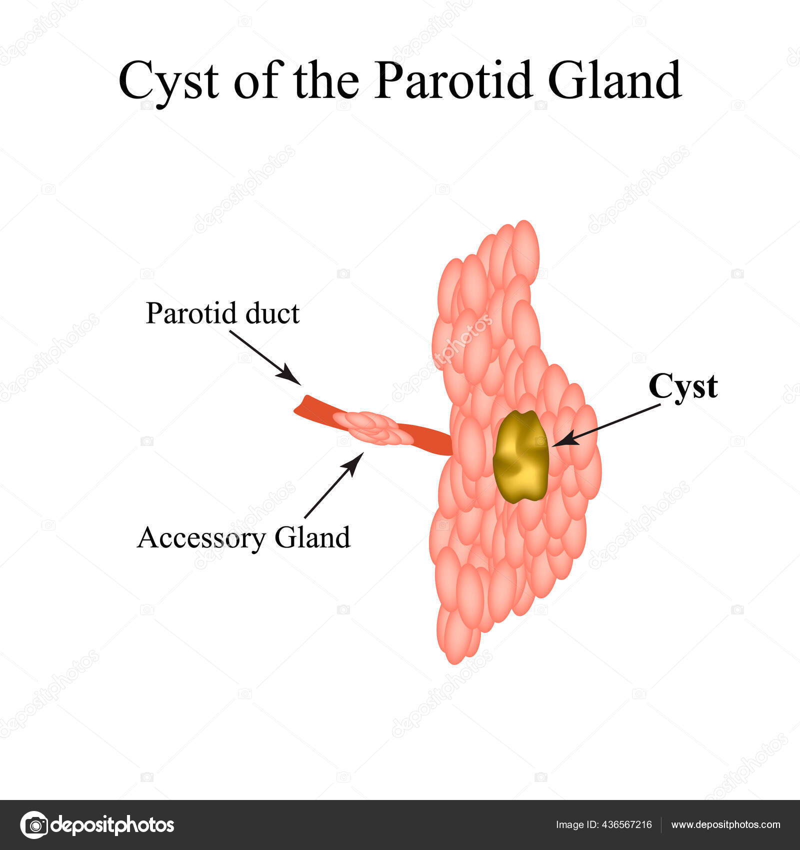 Prostatitis ciszta