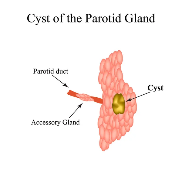 Parotid 침 샘 낭종입니다. 격자무늬 타액 분비선의 구조. 외진 곳에 있는 벡터 그림 — 스톡 벡터