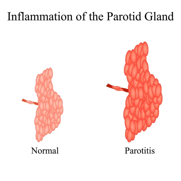 Inflamación de la glándula parótida.La estructura de la glándula salival parótida. Ilustración vectorial sobre fondo aislado — Archivo Imágenes Vectoriales