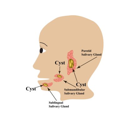Parotid tükürük bezi. Submandibular tükürük bezi. Dil altı tükürük bezi. Kist. İzole edilmiş arkaplanda vektör illüstrasyonu