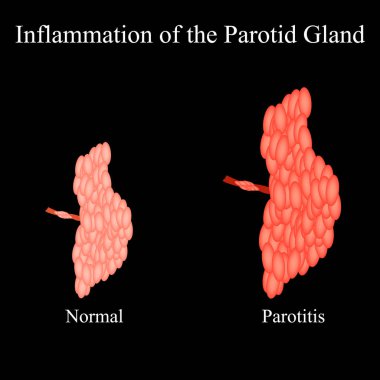Parotid bezinde iltihap. Parotid tükürük bezinin yapısı. İzole edilmiş arkaplanda vektör illüstrasyonu