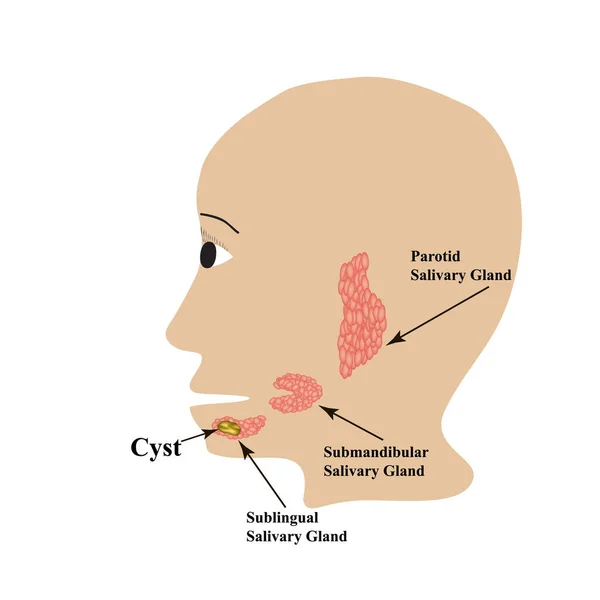 Glándula salival parotídea. Glándula salival submandibular. Glándula salival sublingual. quiste. Ilustración vectorial sobre fondo aislado — Archivo Imágenes Vectoriales