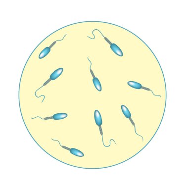Sperm sayısı düşük. Boşalıktaki sperm miktarı çok azdı. Erkek kısırlığı Oligospermia. Spermogram. Patoloji tipleri. Sperm kusurları. Spermin yapısı. Bilgi Grafikleri .