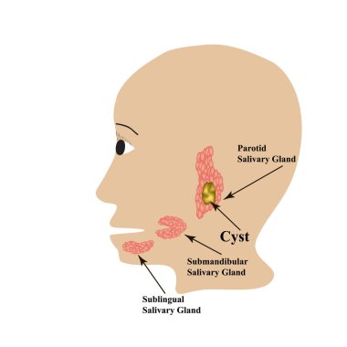 Parotid tükürük bezi. Submandibular tükürük bezi. Dil altı tükürük bezi. Kist. İzole edilmiş arkaplanda vektör illüstrasyonu