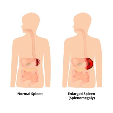Splenomegaly of the spleen. Enlargement of the spleen. Vector illustration on isolated background clipart
