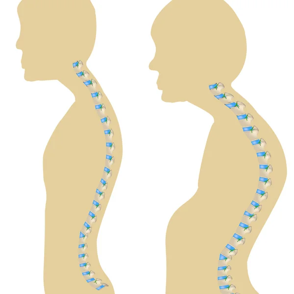 脊椎のカイフォシス。正常姿勢とカイフォシス.孤立した背景のベクトル図 — ストックベクタ