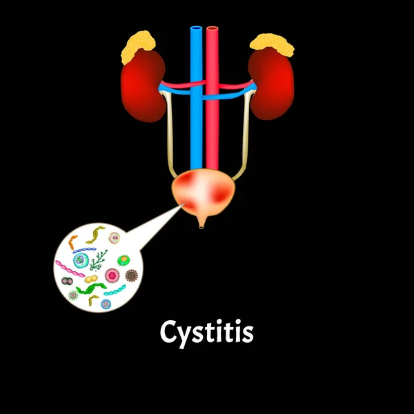 Cystitis. Ontsteking van de blaas. De structuur van de nieren en blaas. Uitscheidingssysteem. Infografieën. Vectorillustratie. — Stockvector