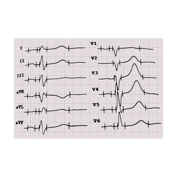 Cardiograma. Batimento cardíaco. O gráfico sobre papel gráfico. Ilustração vetorial sobre fundo isolado — Vetor de Stock