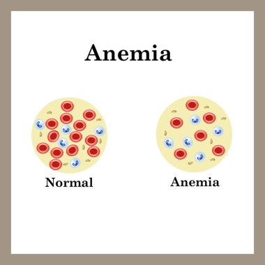 Anemi var. Alyuvar sayısı azaldı. Bilgi grafikleri. Vektör illüstrasyonu