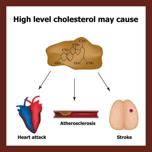 Causas de colesterol alto - ataque cardíaco, accidente cerebrovascular, aterosclerosis. Una fórmula química. placas. Infografías. Ilustración vectorial — Vector de stock