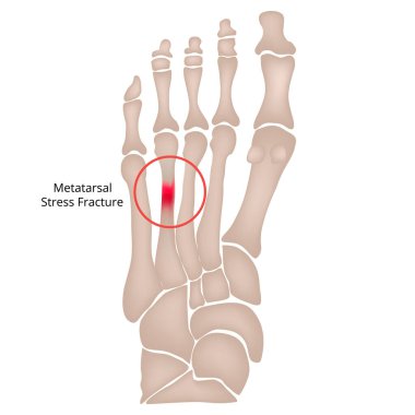 Stress fracture. Marching fracture of the foot. Fracture of the metatarsal bones in the foot. Anatomical structure of the foot. Skeleton. Broken bones. Vector illustration on isolated background. clipart