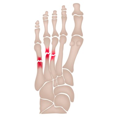 Ayağındaki metatarsal kemiklerde kırık var. Ayağın anatomik yapısı. İskelet. Kırık kemikler. İzole edilmiş arkaplanda vektör illüstrasyonu