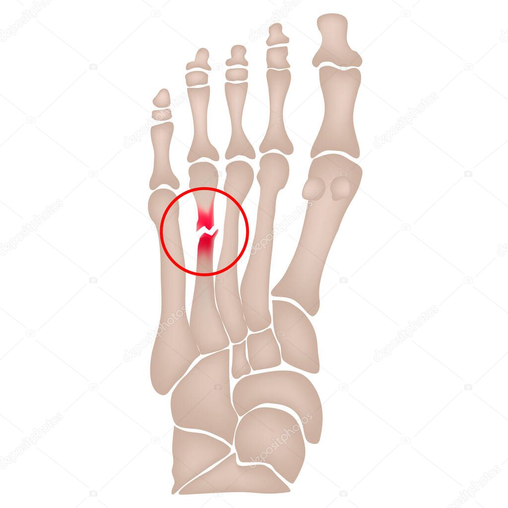 Fracture of the metatarsal bones in the foot. Anatomical structure of the foot. Skeleton. Broken bones. Vector illustration on isolated background