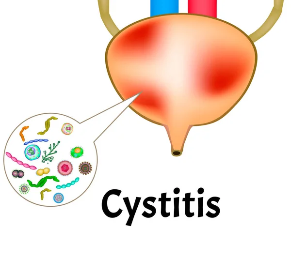 Cistitis. Inflamación de la vejiga. Estructura de los riñones y la vejiga. Sistema excretor. Infografías. Ilustración vectorial sobre fondo aislado . — Archivo Imágenes Vectoriales