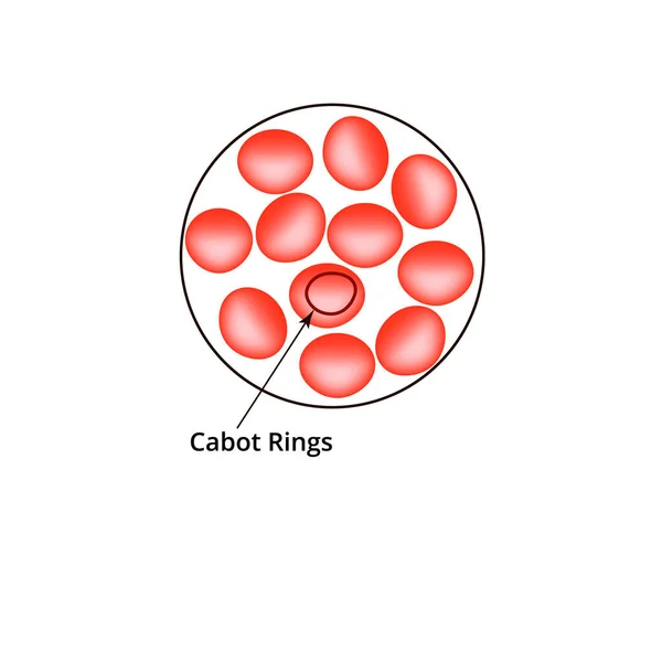 Cabot suona. Anemia del sangue. I globuli rossi sono eritrociti nel sangue. Illustrazione vettoriale su sfondo isolato — Vettoriale Stock