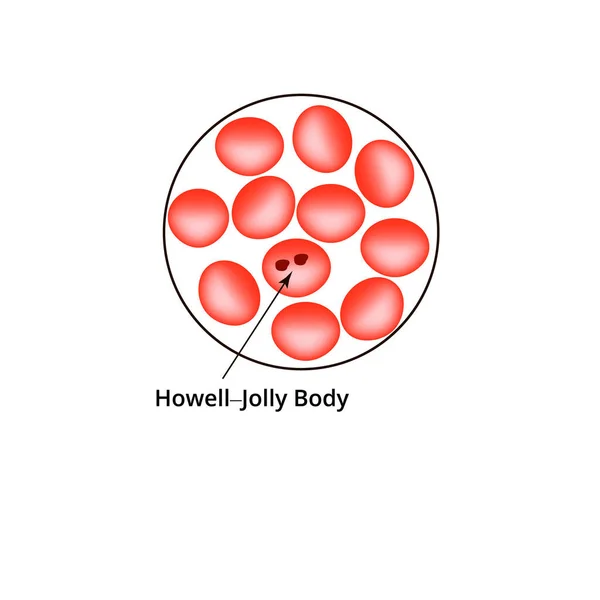 Cuerpo Howell Jolly. Anemia de la sangre. Los glóbulos rojos son eritrocitos en la sangre. Ilustración vectorial sobre fondo aislado — Vector de stock