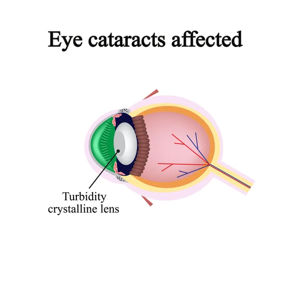 La struttura dell'occhio. Cataratta oculare colpita. Le violazioni si verificano quando una cataratta — Vettoriale Stock