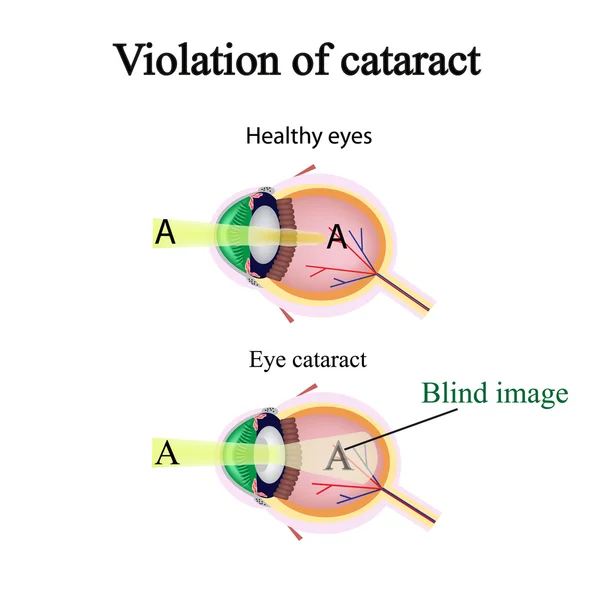 La struttura dell'occhio. Cataratta. Come l'occhio colpito vede cataratta. Violazione della cataratta — Vettoriale Stock