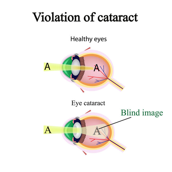 The structure of the eye. Cataracts. As the affected eye sees cataracts. Violation of cataract