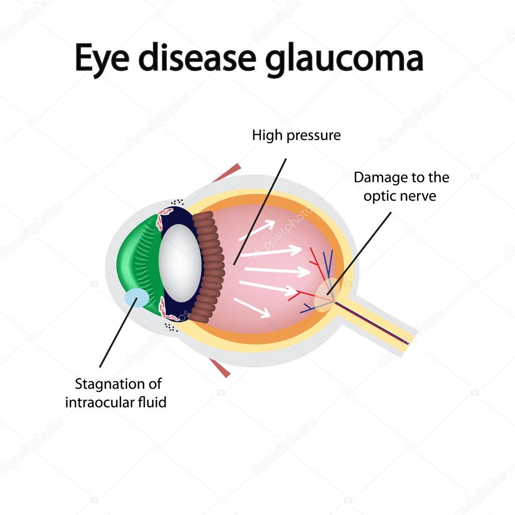 Glaucomatous eye. Violations causing glaucoma