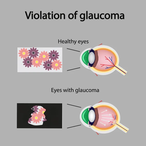 A estrutura do olho. Visão turva em glaucoma. Como o olho pode ver o afetado com glaucoma — Fotografia de Stock