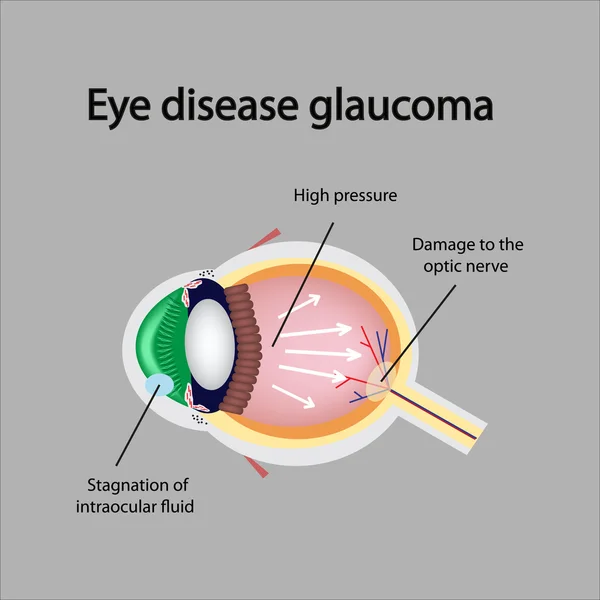 Ojo glaucomatoso. Violaciones que causan glaucoma — Vector de stock