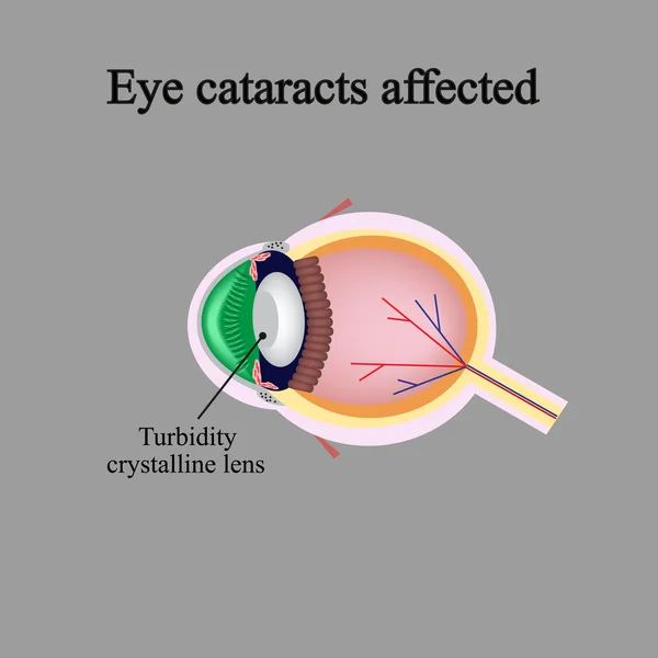 La struttura dell'occhio. Cataratta oculare colpita. Le violazioni si verificano quando una cataratta — Vettoriale Stock