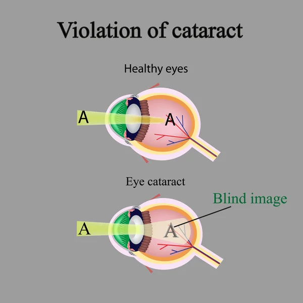 La structure de l'œil. Cataractes. Comme l'œil affecté voit des cataractes. Violation de la cataracte — Image vectorielle