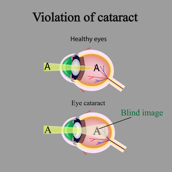 The structure of the eye. Cataracts. As the affected eye sees cataracts. Violation of cataract