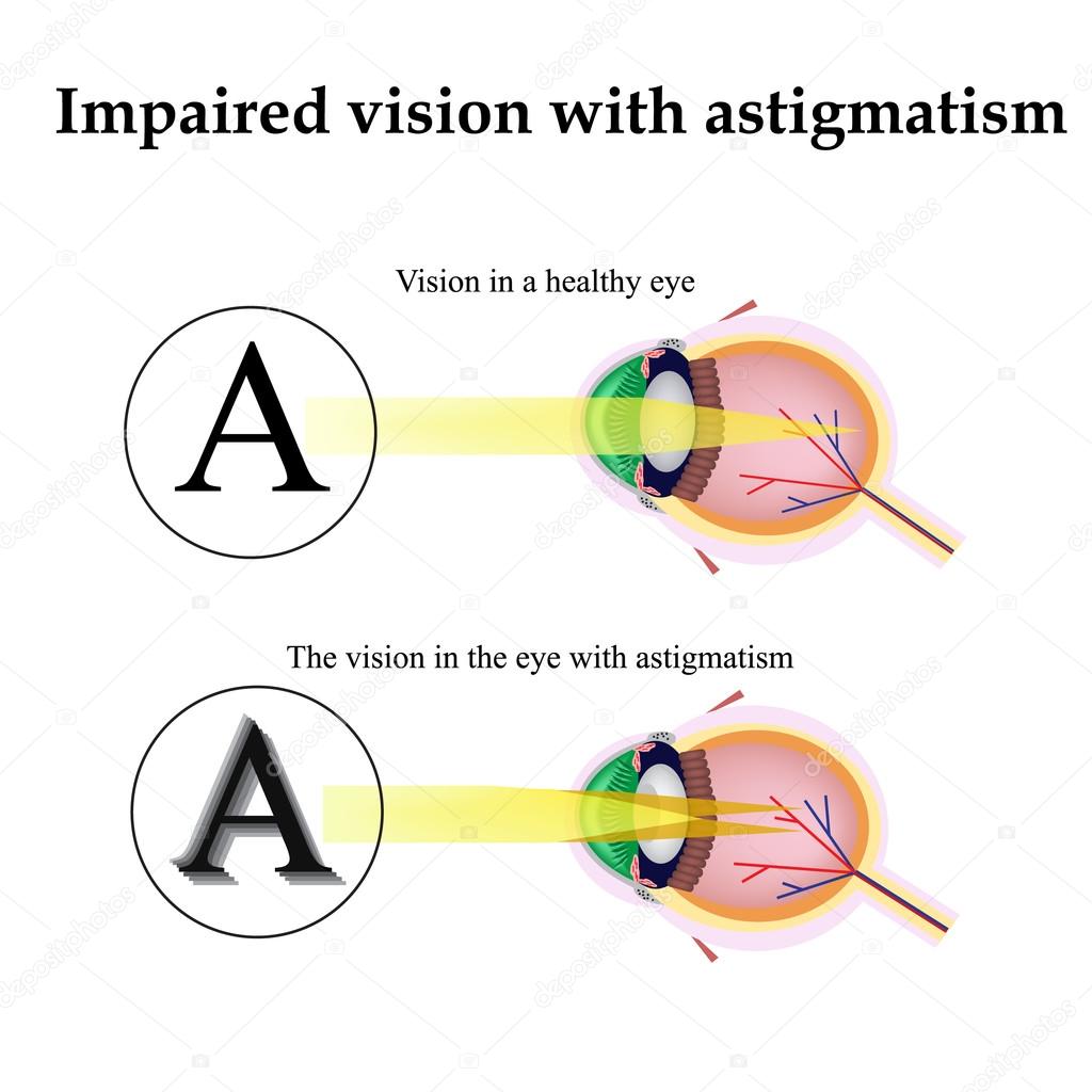 Astigmatism. As the eye can see with astigmatism. Impaired vision
