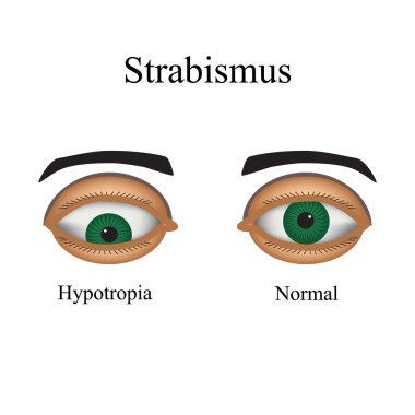 Diseases of the eye - strabismus. A variation of strabismus - Hypotropia clipart