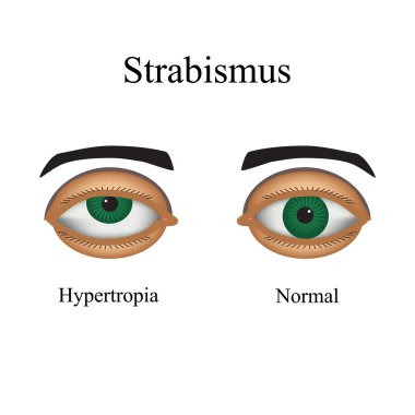 Diseases of the eye - strabismus. A variation of strabismus - Hypertropia clipart