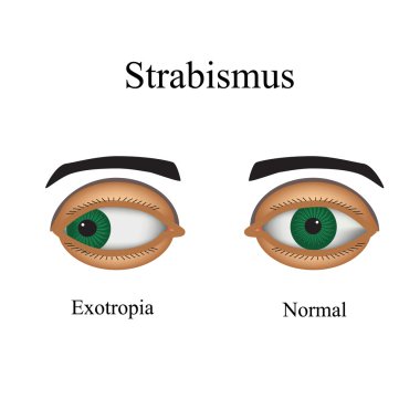 Diseases of the eye - strabismus. A variation of strabismus - Exotropia clipart