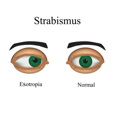 Diseases of the eye - strabismus. A variation of strabismus - Esotropia clipart