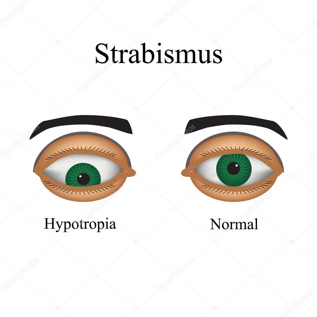 Diseases of the eye - strabismus. A variation of strabismus - Hypotropia