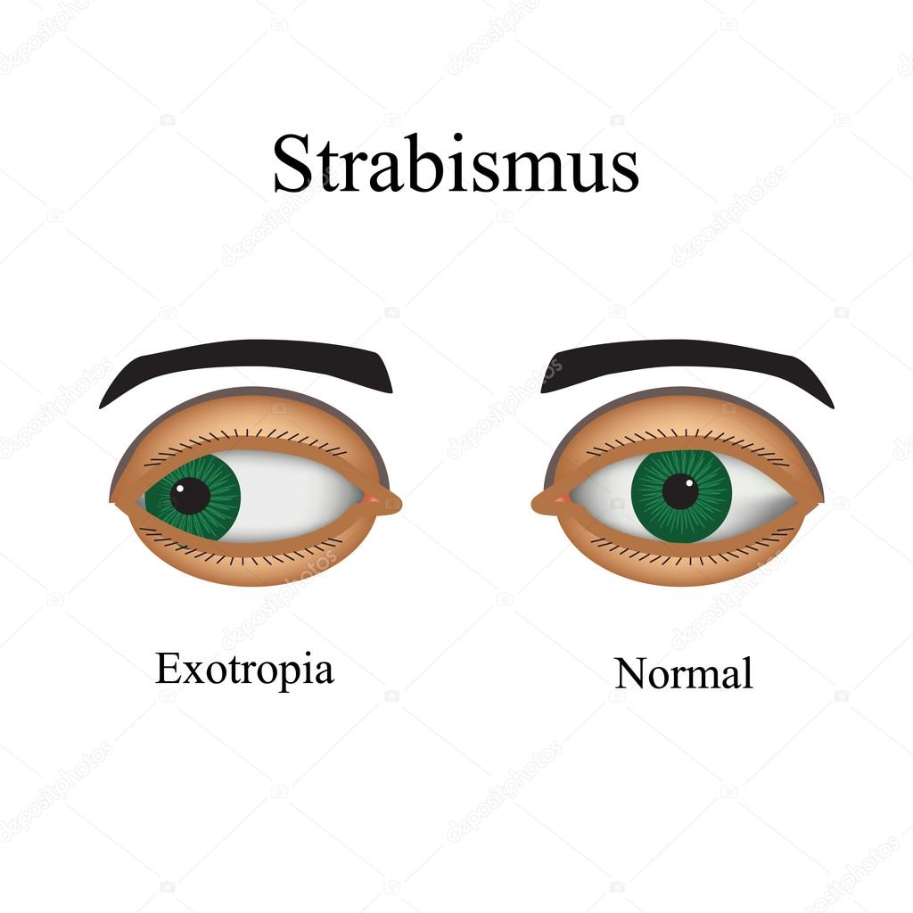 Diseases of the eye - strabismus. A variation of strabismus - Exotropia