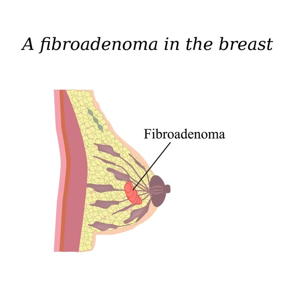 Fibroadenoma in the breast. On isolated background. The structure of the breast. Mammary gland