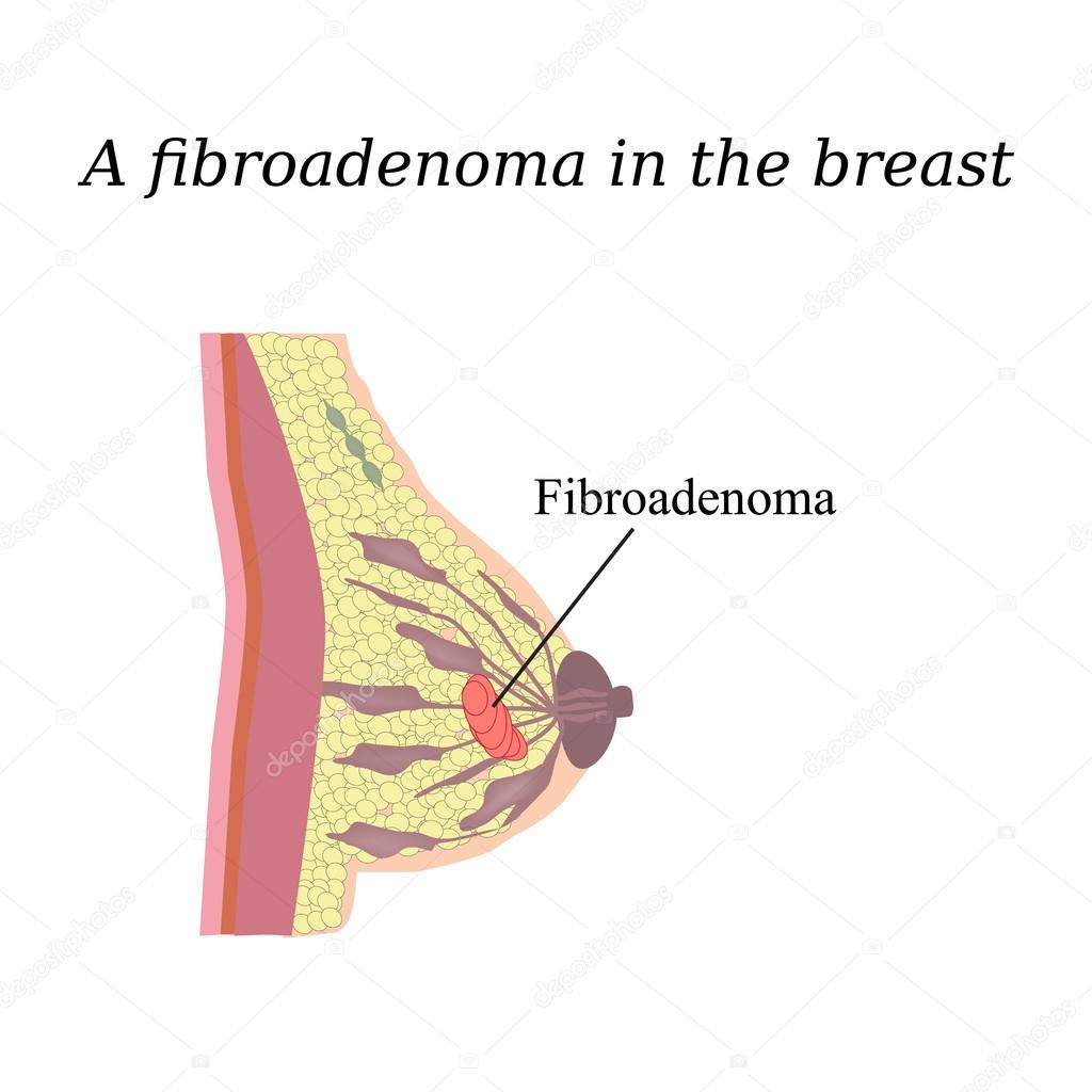 Fibroadenoma in the breast. On isolated background. The structure of the breast. Mammary gland