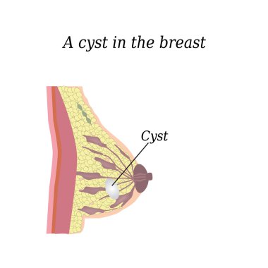 A cyst in the breast. On isolated background. The structure of the breast. Mammary gland