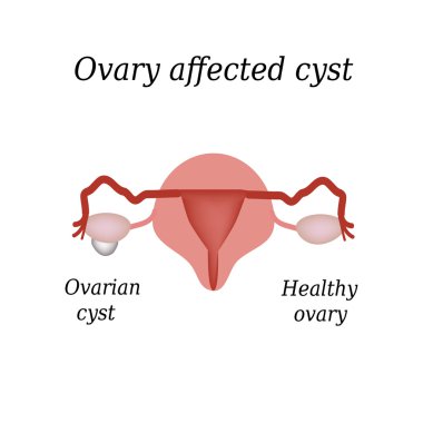 A cyst in the ovary. Pelvic organs. Vector illustration on isolated background