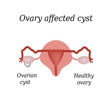 A cyst in the ovary. Pelvic organs. Vector illustration on isolated background clipart