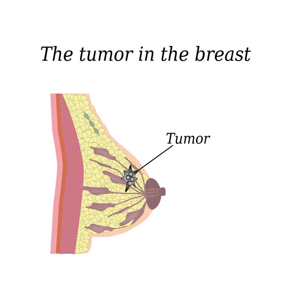 O tumor na mama. Em fundo isolado. A estrutura do peito. Glandula mamária . — Vetor de Stock