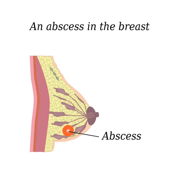 An abscess in the chest. On isolated background. The structure of the breast. Mammary gland — Stock Vector