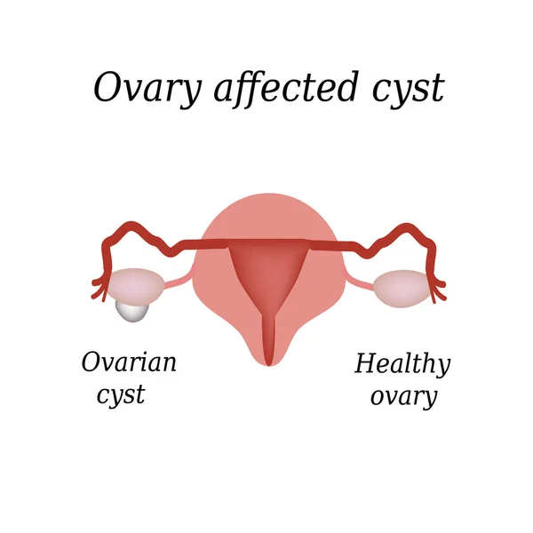 A cyst in the ovary. Pelvic organs. Vector illustration on isolated background — ストックベクタ