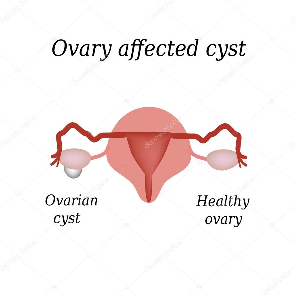 A cyst in the ovary. Pelvic organs. Vector illustration on isolated background