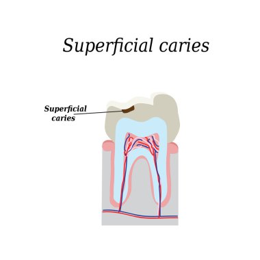 Home tooth caries. Vector illustration on isolated background